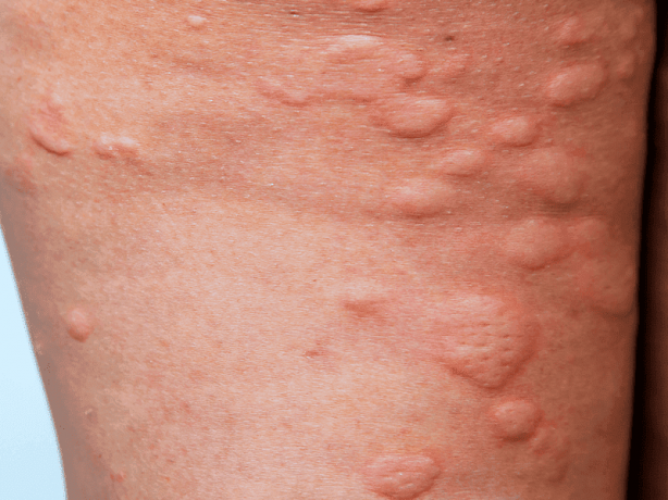 hives specialists
