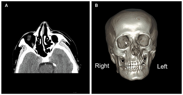 The Rising Prevalence of Parry Romberg Syndrome Market will Drive Market Growth owing to Improved Diagnosis