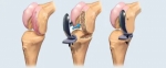 Why Are Knee Replacements So Expensive? A Cost Breakdown