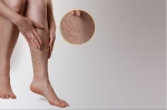 Vein Treatment Long Island: Get Rid of Varicose Veins Without Surgery