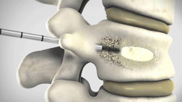 Bone Cement Market Primed for Growth With 3D Printing Advancements