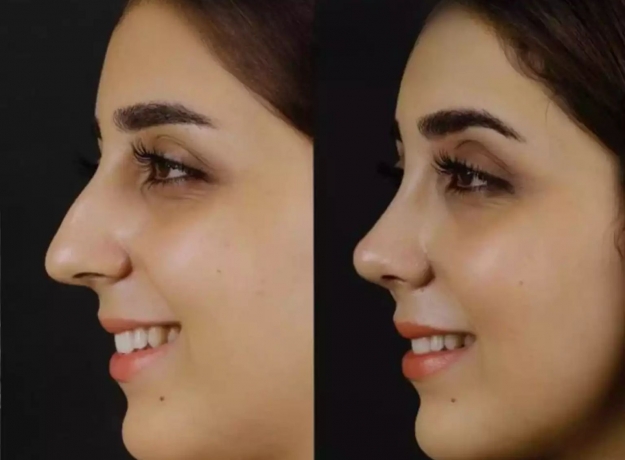 What Facilities Are Available at the Clinic of the Best Septoplasty Surgeon in Dubai?