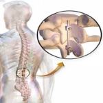 Spinal Non Fusion Device: A Promising Alternative to Spinal Fusion Surgery