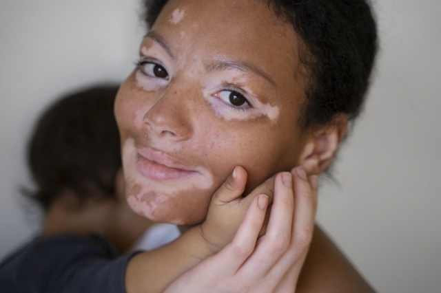 The Vitiligo Drugs Market is set to see significant growth through focus on harnessing natural pigmentation