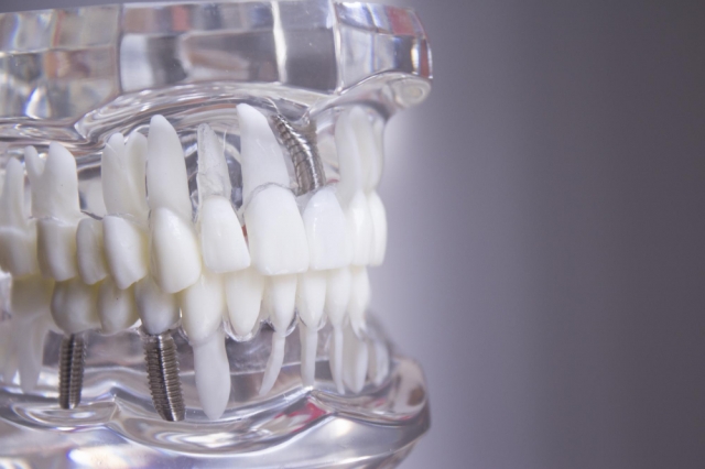 multiple dental implants