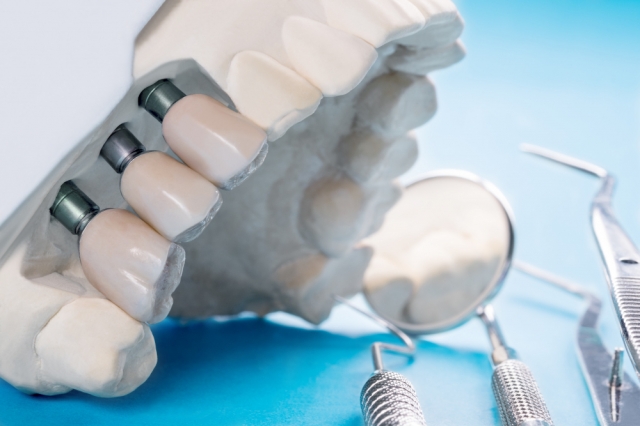 Dental Implants or Bridges? Discover A Best Choice for You