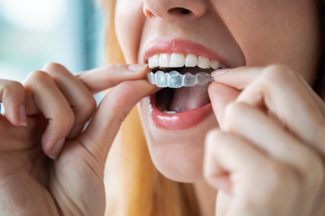 Aligners, A Subtle, Effective Alternative to Traditional Braces