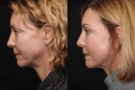 Expert Advice on Balancing Rhinoplasty's Aesthetics and Functionality  