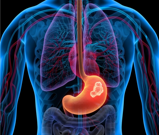 Rising Adoption of Targeted Therapy Drugs to Drive Growth of the Gastrointestinal Stromal Tumor (GIST) Market