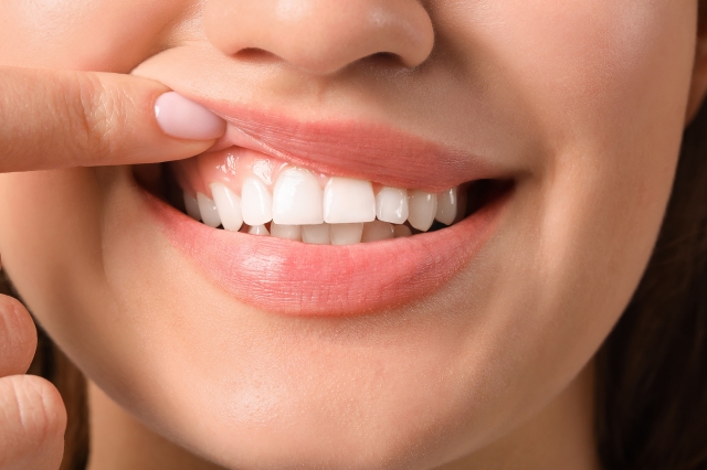 Gingivectomy, A Surgical Solution for Healthier Gums