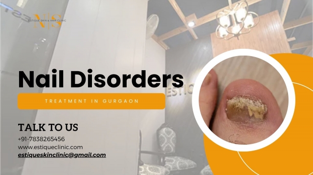 Understanding Nail Disorders: Types, Causes and Treatment Options