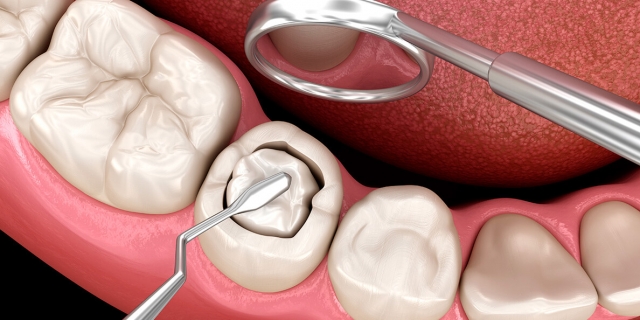 Where to Get the Best Composite Filling for Front Teeth