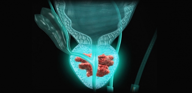 Metastatic Prostate Cancer Market is Estimated to Witness High Growth Owing to Advancements 