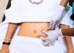 Lemon Bottle Injections: A Revolutionary Solution for Fat Reduction