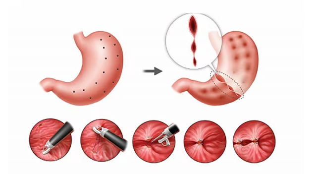 Endoscopic Sleeve Gastroplasty in Atlanta: Cost, Benefits & What to Expect