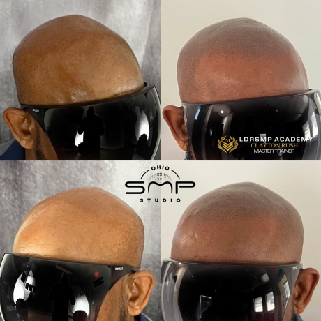 Discover the Life-Changing Benefits of Scalp Micropigmentation in Sandusky