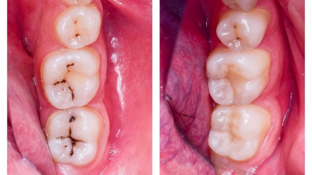 The Benefits of Composite Fillings for a Natural-Looking Smile