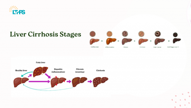 Liver Cirrhosis Stages