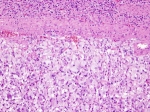 The Pheochromocytoma Treatment Market is driving by rising incidence of pheochromocytoma