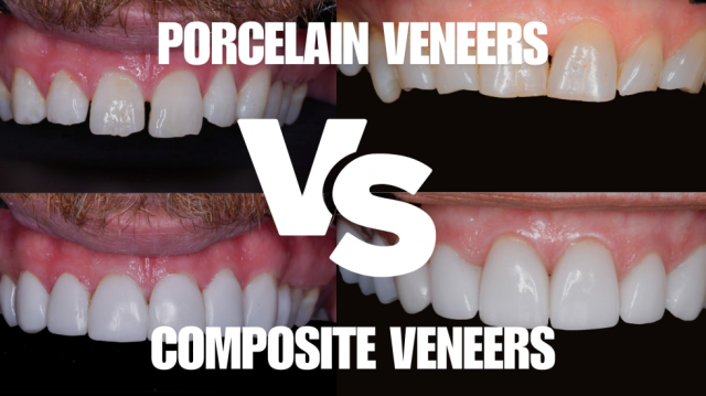 Porcelain vs. Composite Veneers: Which One Will Give You the Perfect Smile?