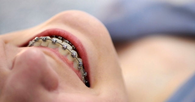 What Happens After You Get Your Braces Off? Post-Treatment Care Explained