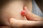 Expert Skin Tag Removal in Riyadh: No More Skin Imperfections!