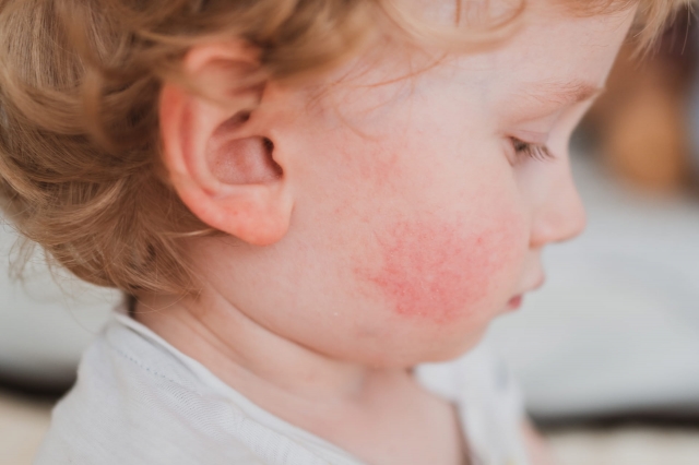 10 Reasons Why Pediatric Skin Conditions Like Eczema Flare in Children