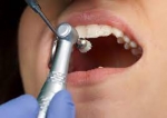 Everything You Need to Know About Teeth Scaling and Polishing
