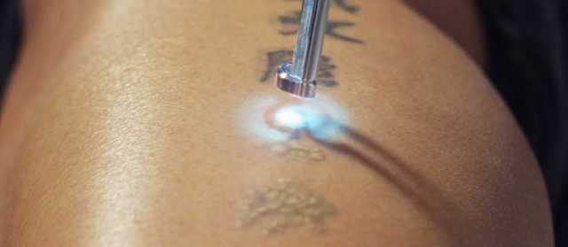 Oops! Ink Regret? No Problem – Laser Tattoo Removal Got You Covered!