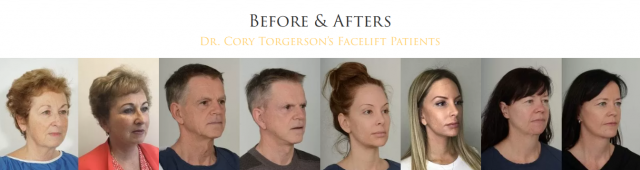 Rejuvenate Your Look with a Mini Facelift in Toronto