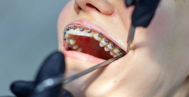 What Are Teeth Braces?