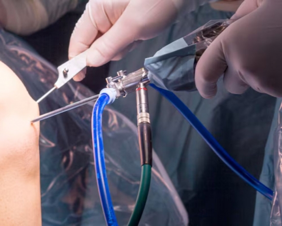 What is Shoulder Arthroscopy? Benefits and Recovery Guide