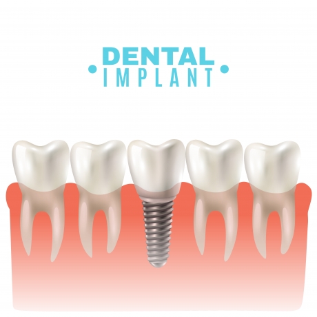 How Long Do Dental Implants Last? Expert Insights from South London Dentists!