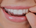 How Long Should You Wear Your Retainer?
