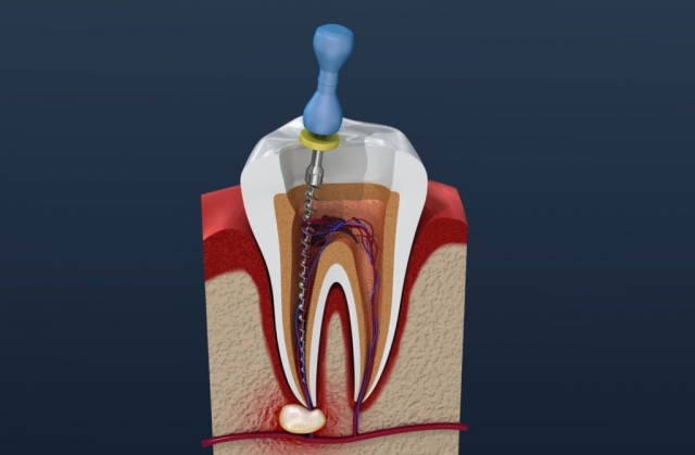 Why You Should See a Root Canal Specialist for Treatment