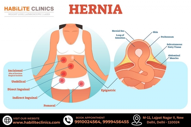 Different Types of Hernias and Their Treatments Explained