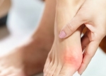 Top 5 Bunion Treatment Options in Singapore for Pain-Free Feet