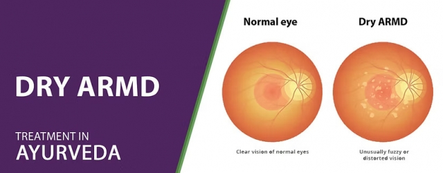 Your Guide to Treating Dry AMD Naturally and Medically