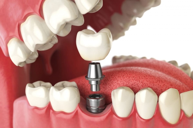 Are Dental Implants the Right Solution for Missing Teeth?