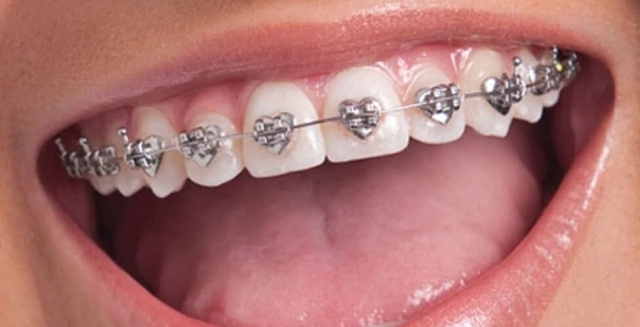 The Complete Guide to Types of Dental Braces in Dubai