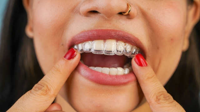 The Role of Dental Appliances in Preventive Dentistry