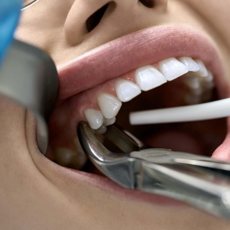 Tooth Extraction, Myths vs. Facts