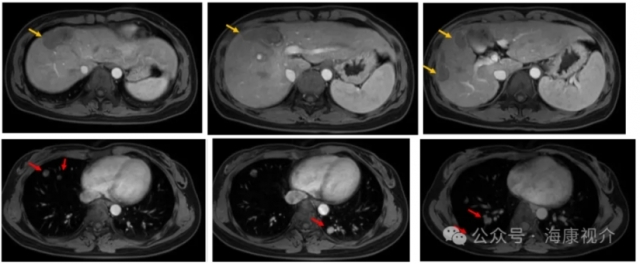 Case Sharing | Cryosurgical System for Lung metastasis of liver cancer