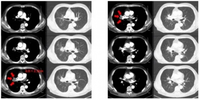 Case Sharing | Cryosurgical System for Lung Metastatic Malignant Tumors