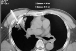 Advantages and Research of Cryoablation Pancreatic Cancer