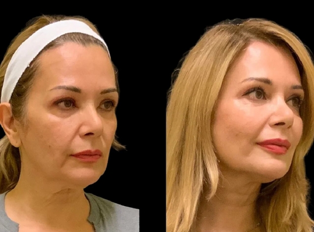 Best Doctors in Dubai: Achieving a Natural Look with Cheek Fillers