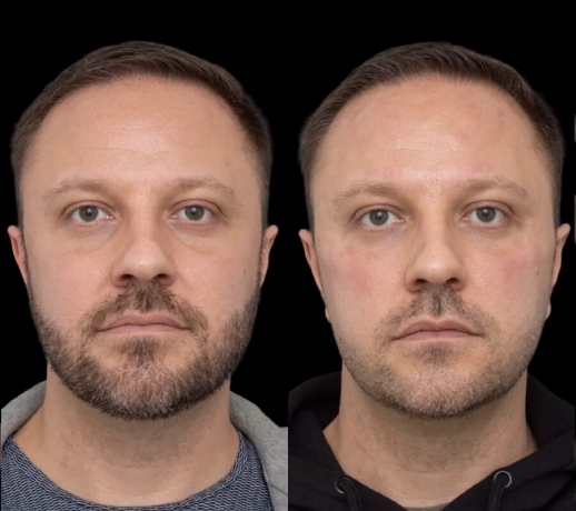 How Best Doctors in Dubai Achieve Subtle Results with Under Eye Fillers