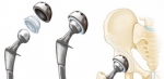 Choosing the Right Surgeon for Hip Surgery in Islamabad: What You Need to Know