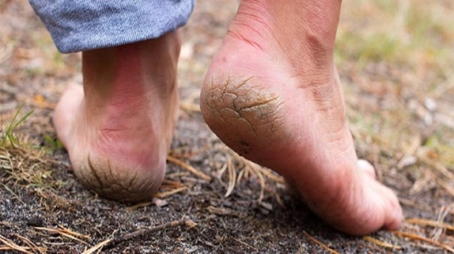 Palmoplantar Keratoderma Market Set to Experience Substantial Growth Due to Rising Genetic Skin Disorder Cases