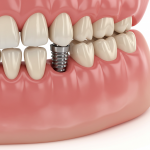 North America Dental Implants Market Competitive Landscape and Trends by Forecast 2028